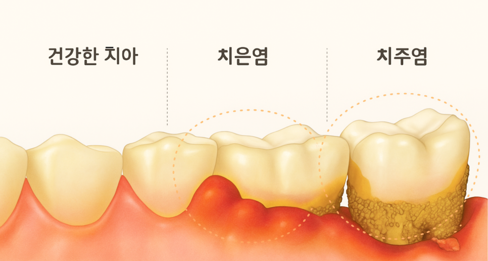 영등포구청역 치과 임플란트 수술 왜 기다렸다 하나요? ft. 발치와 보존술 관련 이미지 1