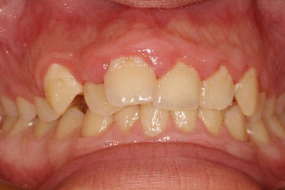 당산동 치과 임산부 치아 치료 시기별 주의해야 될 점 및 보험 혜택 관련 이미지 4