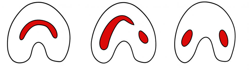 자연치 보존을 방해하는 C형 근관 : 당산동 치과 신경치료 관련 이미지 3