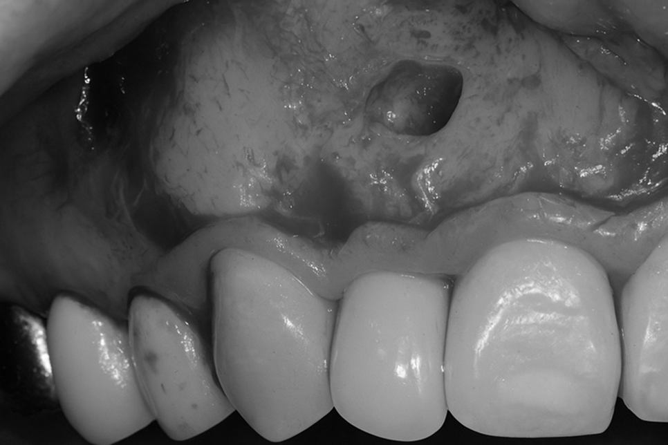 당산동 치과 신경치료 실패 후 치근단 절제술 Feat.미세 현미경 관련 이미지 5