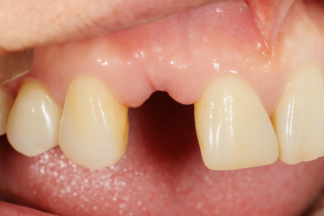 영등포구청역 치과 임플란트 수술 왜 기다렸다 하나요? ft. 발치와 보존술 관련 이미지 5