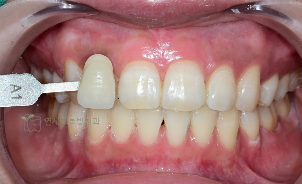 당산동 치과 원데이 화이트닝, 미백 치약보다 효능 확실한 이유는?! 관련 이미지 7