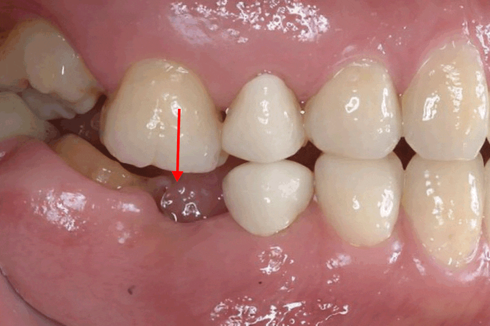 영등포구청역 치과 치아 상실 시 발생할 수 있는 구강 내 문제점은 무엇이 있을까? 관련 이미지 3