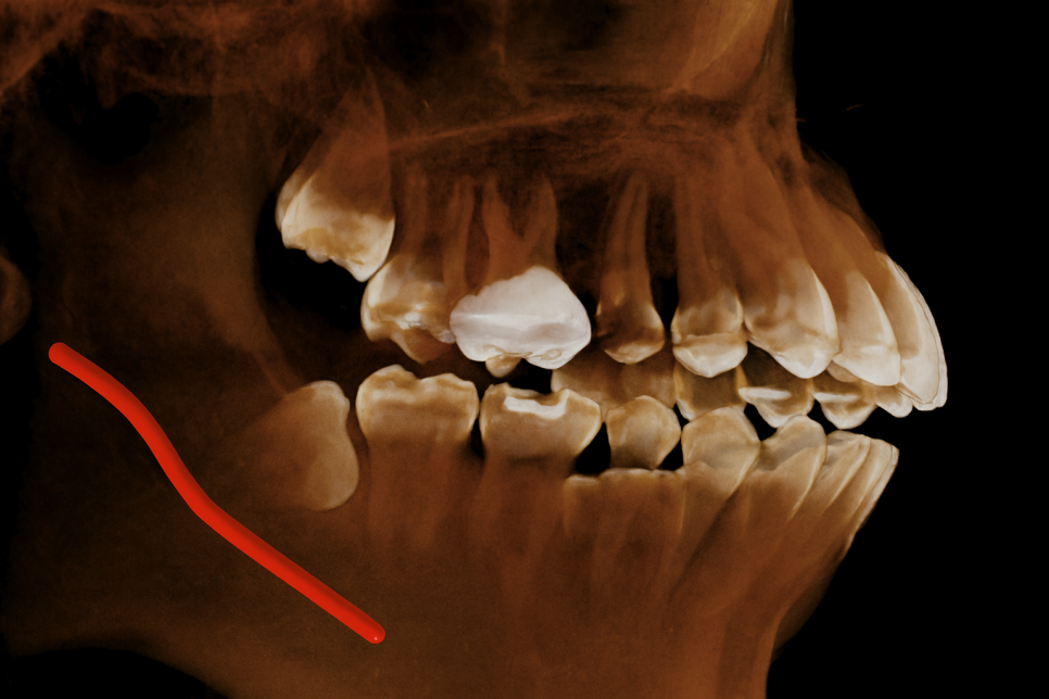영등포동 치과 사랑니 발치 후 식사, 언제부터 가능할까? ft. 하치조 신경관 관련 이미지 3
