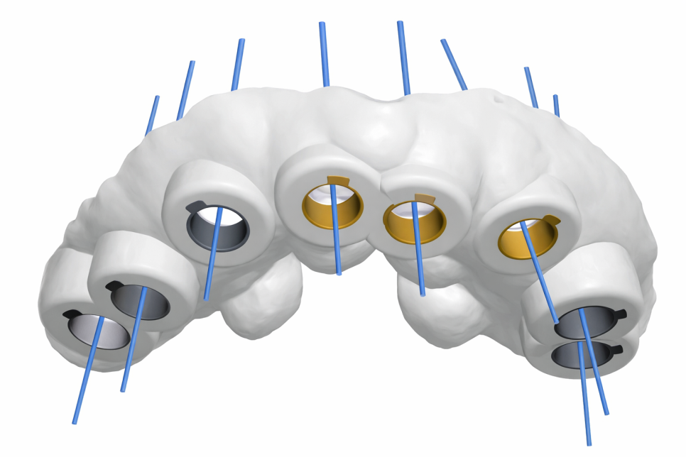 선유도역 치과 네이게이션 임플란트, 어떻게 진행될까? 관련 이미지 7