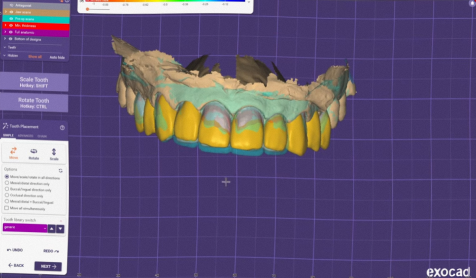 The Process of Creating Aesthetic Prosthetics Using a 3D Oral Scanner at the National Assembly Building Dental Clinic! image 8