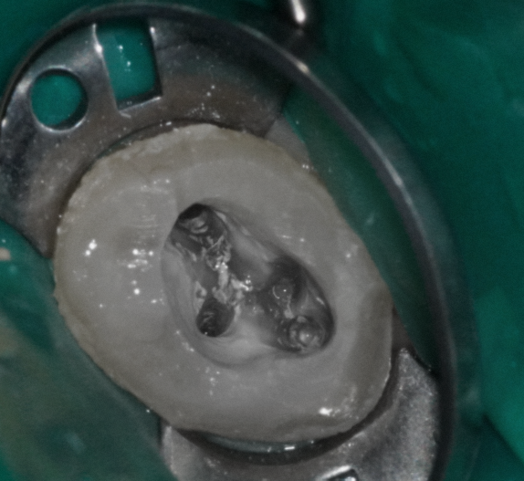 영등포 치과 신경치료 후 재발한 통증,  미세현미경 신경치료 로 해결할 수 있을까요? 관련 이미지 5