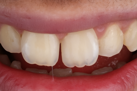 당산역 치과 아이콘 레진이란? : 치아 탈회 및 교정 치료 후 화이트 스팟 관련 이미지 2