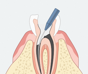 Yeongdeungpo-gu Office Station Dental Clinic: Tooth Wear—Is It Okay to Leave Teeth That Are Gradually Wearing Down Alone? image 2