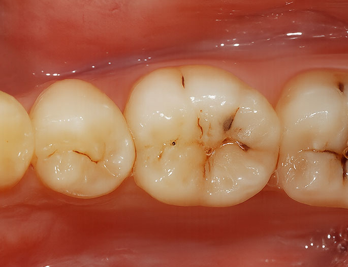 당산동 치과 : 레진 치료가 필요한 상황은 언제일까요? 초기 우식 & 앞니 벌어짐 & 파절 등 관련 이미지 3