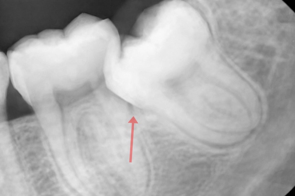 수평 매복 사랑니 예방적 발치가 필요할 때는? 선유도역 치과 Ft. 인접치 우식 & 치조골 흡수 등 관련 이미지 1