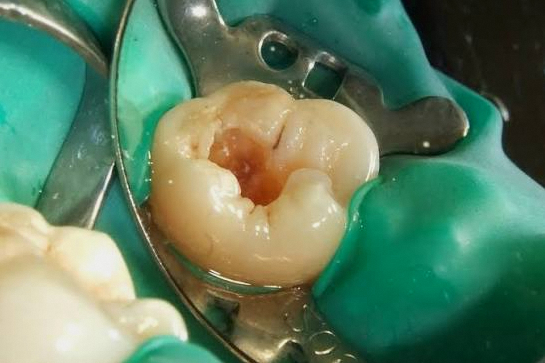 Why the Rubber Dam in Your Mouth Is Essential During Root Canal Treatment at a Dangsan Station Dental Clinic image 4