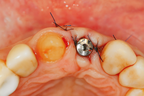 영등포구청역 치과 임플란트 수술 왜 기다렸다 하나요? ft. 발치와 보존술 관련 이미지 4