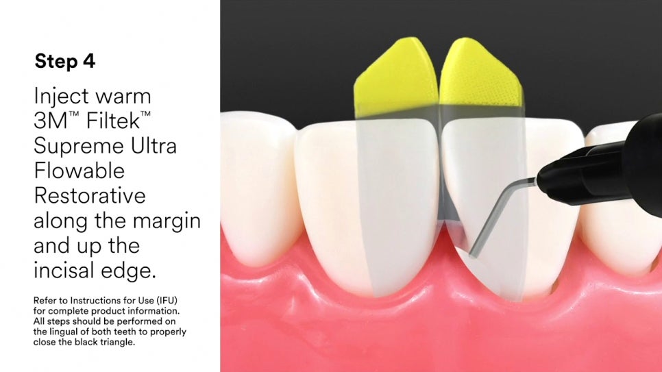 Dangsan-dong Dental Clinic: Were You Disappointed with Your Front Tooth Composite Result? Anterior Tooth Restoration Using the BioClear Matrix image 5