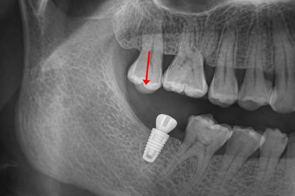 잇몸을 열지 않아 회복이 빠른 무절개 임플란트 당산역 치과 에서 flapless implant 장점에 대해 알려드립니다. 관련 이미지 3