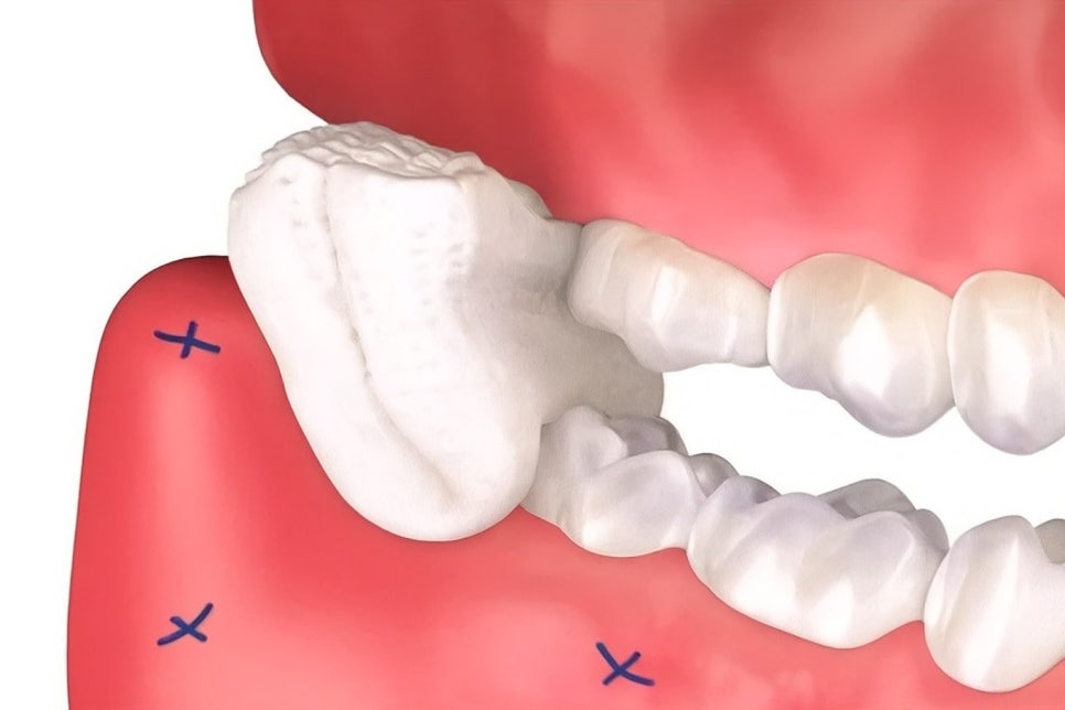 선유도역 치과 : 사랑니 발치 후 생길 수 있는 합병증, 어떻게 예방할 수 있을까? 관련 이미지 4