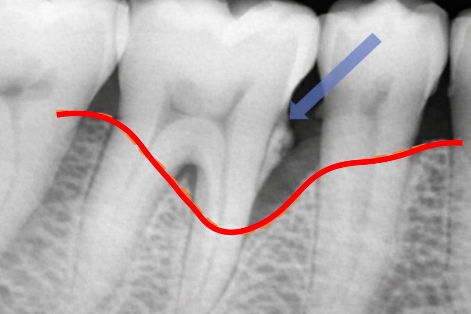 당산 치과 치은연하치석이란? 주기적으로 스케일링 받아야 되는 이유! 관련 이미지 3