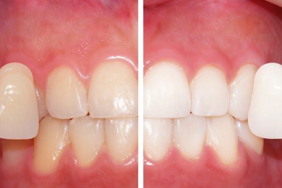 하얀 치아를 가지고 싶다면? 당산역 미백 치과 와 알아보는 시술 과정 관련 이미지 2