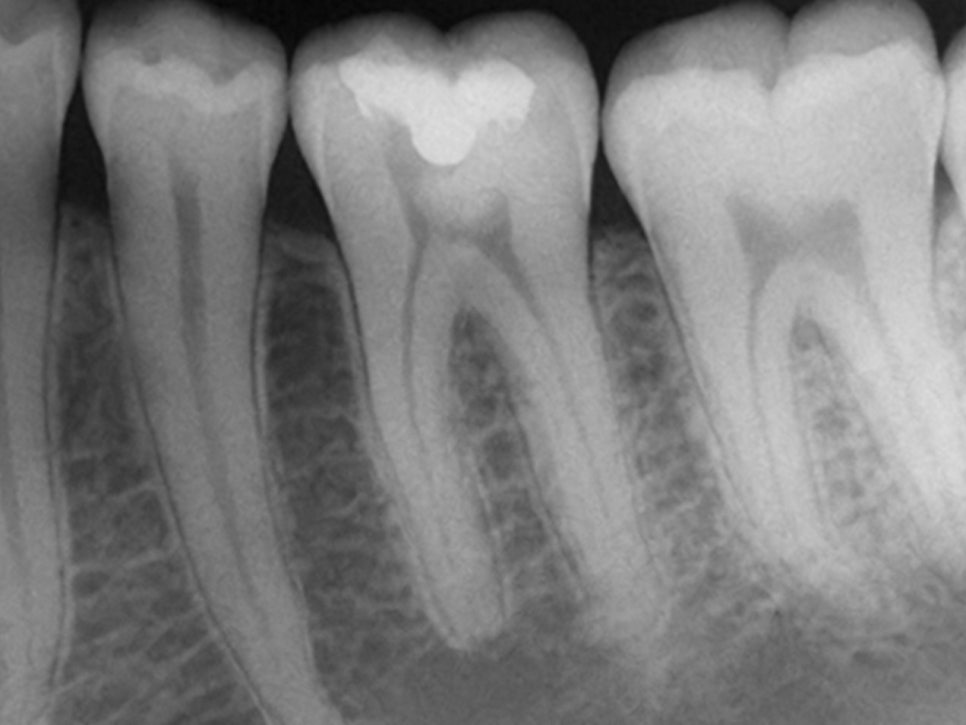 연세초록빛 치과 , 치아 진료 시 환자들이 궁금해하는 질문: 엑스레이(X-ray) 촬영은 왜 필요할까? 관련 이미지 9