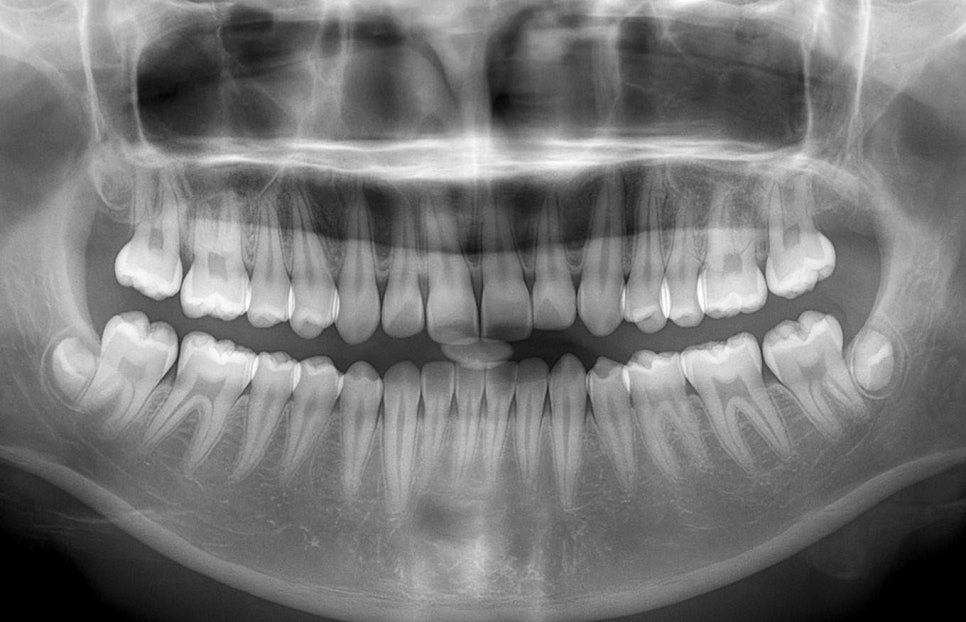 연세초록빛 치과 , 치아 진료 시 환자들이 궁금해하는 질문: 엑스레이(X-ray) 촬영은 왜 필요할까? 관련 이미지 8