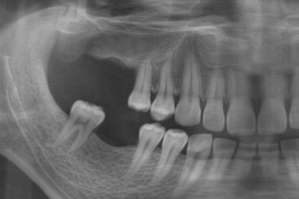 잇몸을 열지 않아 회복이 빠른 무절개 임플란트 당산역 치과 에서 flapless implant 장점에 대해 알려드립니다. 관련 이미지 2