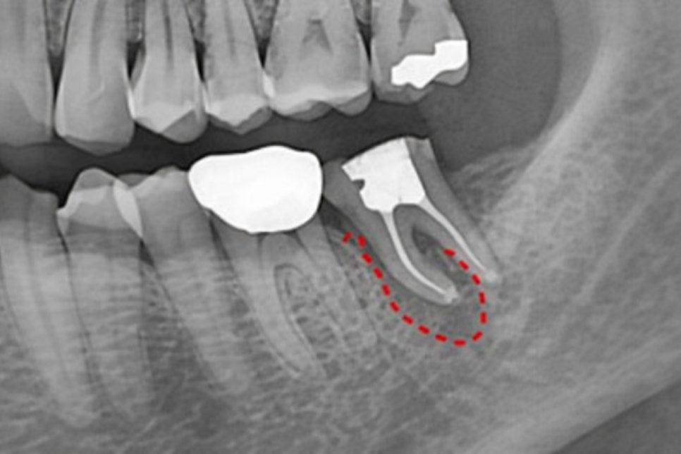 선유도 치과 에서 알려드리는 발치 전 자연치 살리는 마지막 치료 방법 치아재식술 관련 이미지 1