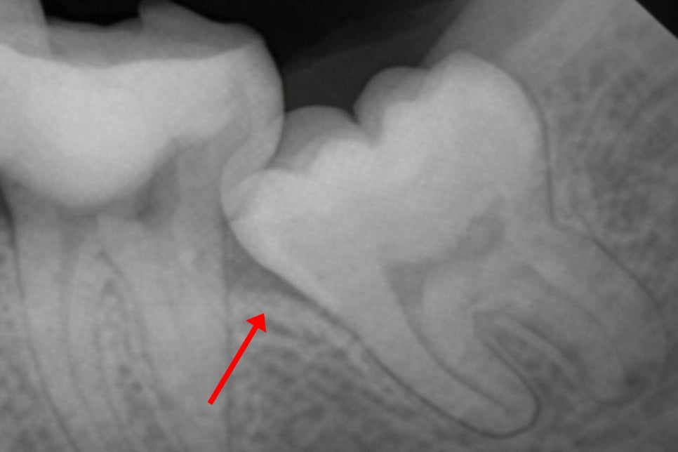 수평 매복 사랑니 예방적 발치가 필요할 때는? 선유도역 치과 Ft. 인접치 우식 & 치조골 흡수 등 관련 이미지 2