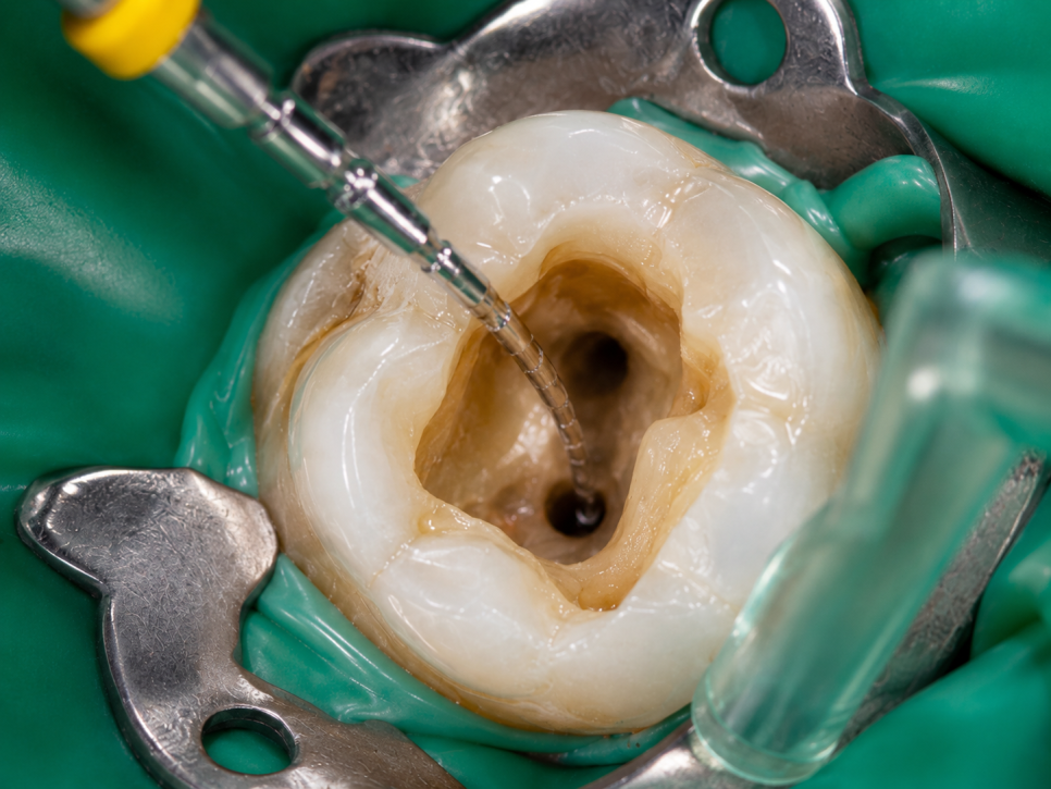 If a Tooth That Underwent Root Canal Treatment Starts Hurting Again at a Yeongdeungpo Dental Clinic: Why Microscope-Assisted Root Canal Retreatment May Be Needed image 4