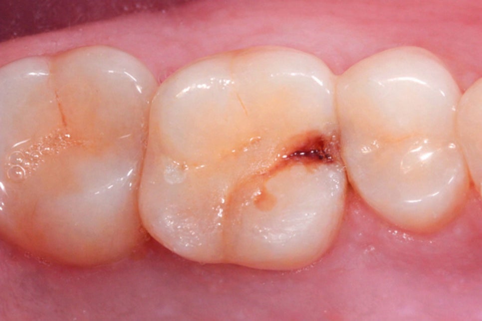 치아 크랙 방치하면 안 되는 이유 파절 증상부터 원인까지 당산 보존치과 에서 알려드립니다! 관련 이미지 6