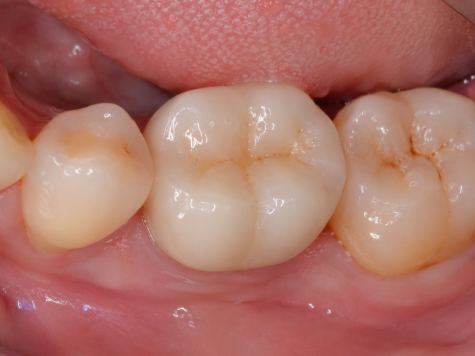 If a Tooth That Underwent Root Canal Treatment Starts Hurting Again at a Yeongdeungpo Dental Clinic: Why Microscope-Assisted Root Canal Retreatment May Be Needed image 5