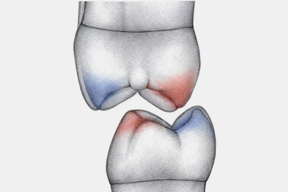 선유도역 치과 보존과 전문의가 설명하는 인레이 vs 온레이 차이점 관련 이미지 4