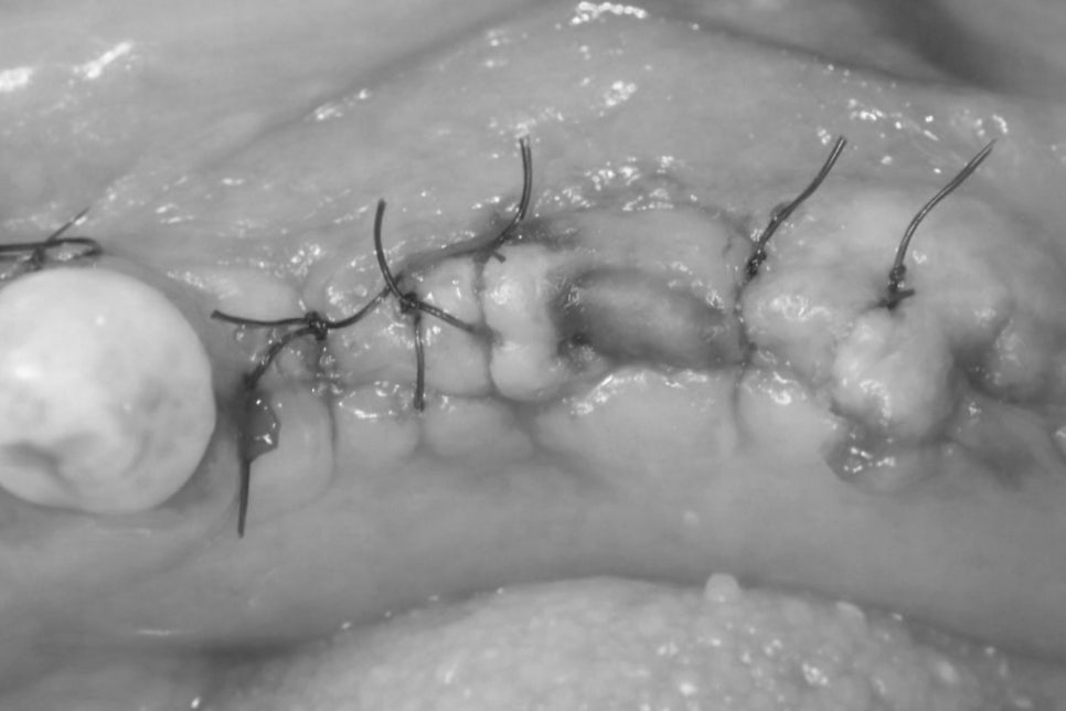 잇몸을 열지 않아 회복이 빠른 무절개 임플란트 당산역 치과 에서 flapless implant 장점에 대해 알려드립니다. 관련 이미지 1