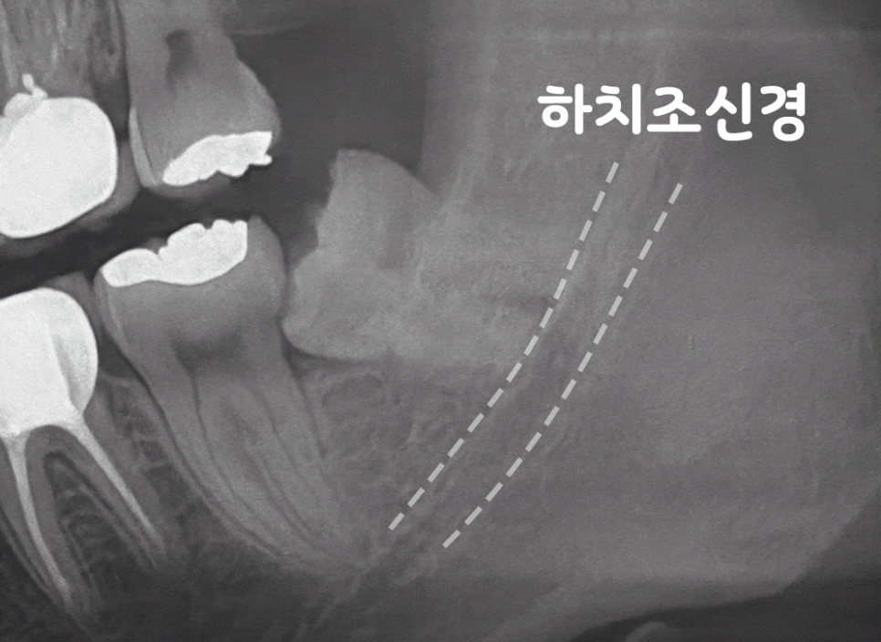 연세초록빛 치과 , 치아 진료 시 환자들이 궁금해하는 질문: 엑스레이(X-ray) 촬영은 왜 필요할까? 관련 이미지 7