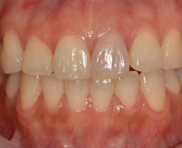 Seonyudo Station Dental Clinic Explains the Essential Steps to Take When a Tooth Is Injured image 5