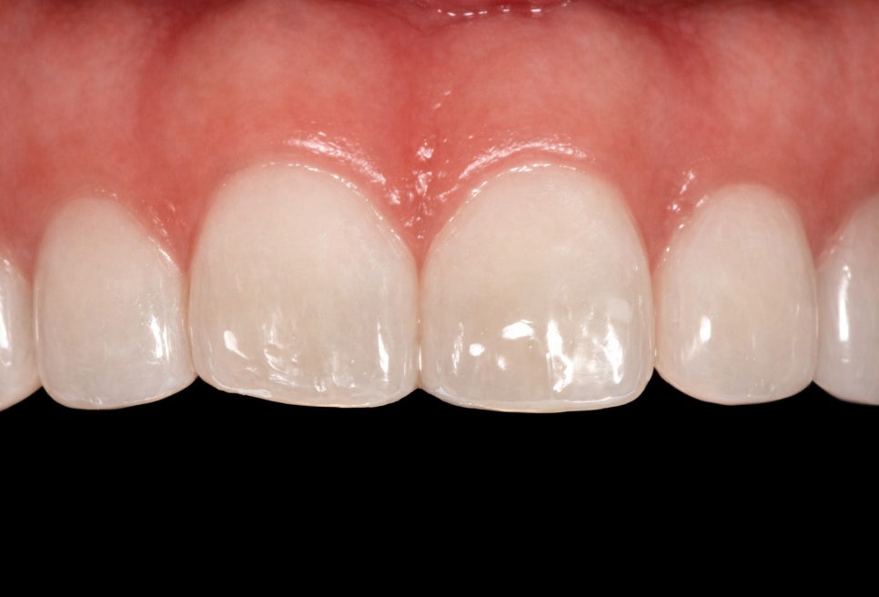 선유도역 치과 벌어진 앞니 다이아스테마 diastema 치료 방법 라미네이트 vs 레진 관련 이미지 4