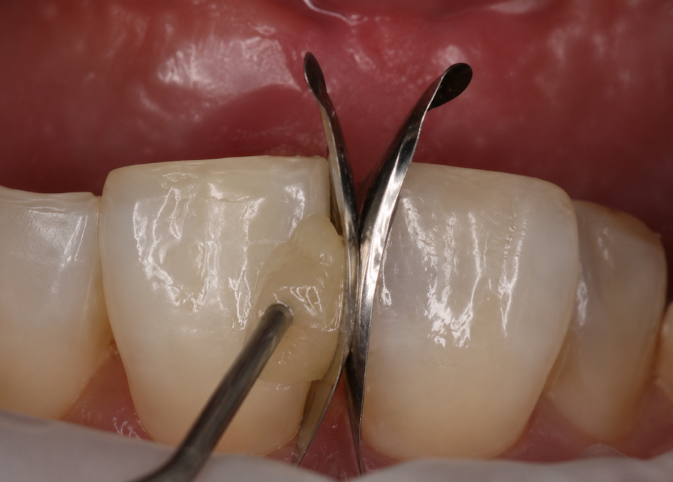 Dangsan-dong Dental Clinic: Were You Disappointed with Your Front Tooth Composite Result? Anterior Tooth Restoration Using the BioClear Matrix image 2
