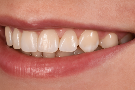 당산역 치과 아이콘 레진이란? : 치아 탈회 및 교정 치료 후 화이트 스팟 관련 이미지 10