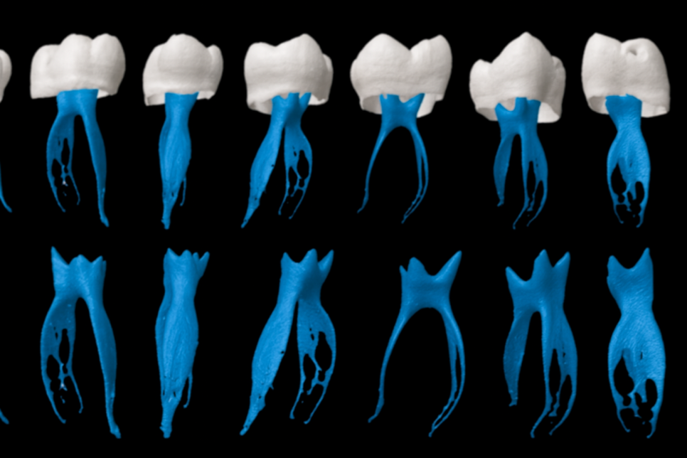 자연치 보존을 방해하는 C형 근관 : 당산동 치과 신경치료 관련 이미지 2