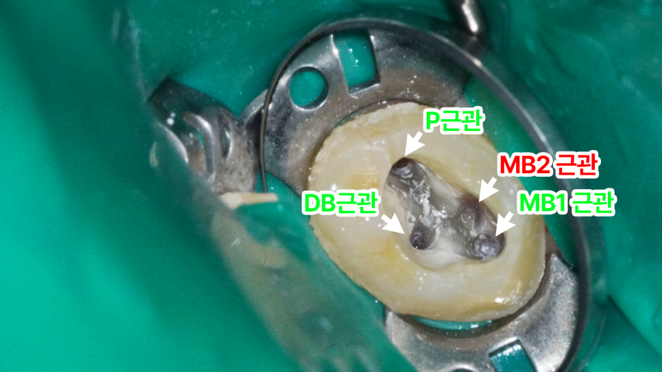당산동 치과 미세현미경을 활용한 재신경치료 : MB2 근관을 찾아라! 관련 이미지 4