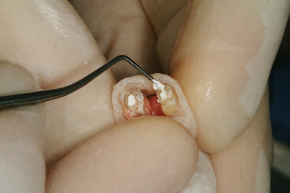 선유도 치과 에서 알려드리는 발치 전 자연치 살리는 마지막 치료 방법 치아재식술 관련 이미지 4