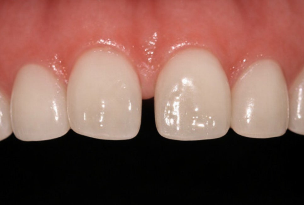 선유도역 치과 벌어진 앞니 다이아스테마 diastema 치료 방법 라미네이트 vs 레진 관련 이미지 3