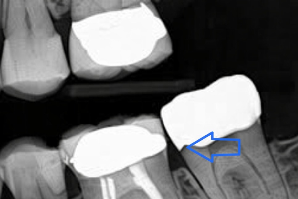치아 파절 & 신경치료, 왜 당산동 치과 미세현미경 필요할까? 관련 이미지 3