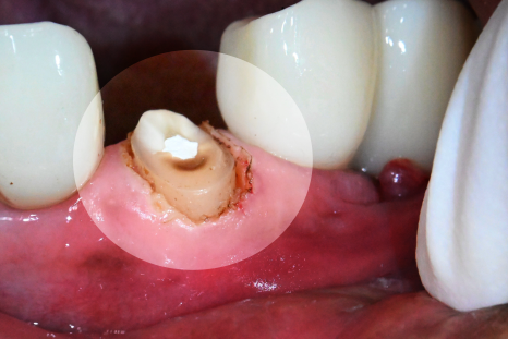 당산동 치과 앞니 파절 : 치관확장술이 필요할 수 있습니다. 관련 이미지 8