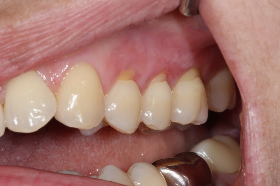 Yeongdeungpo-gu Office Station Dental Clinic: Tooth Wear—Is It Okay to Leave Teeth That Are Gradually Wearing Down Alone? image 1