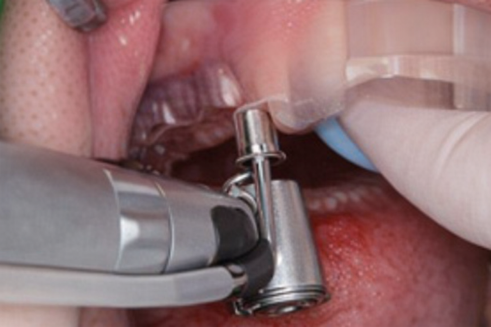 선유도역 치과 네이게이션 임플란트, 어떻게 진행될까? 관련 이미지 9