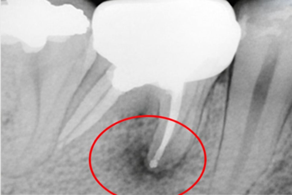 보철 밑에서 조용히 진행되는 2차 우식 - 레진 & 크라운 변연 미세누출 , 당산역 치과 관련 이미지 4