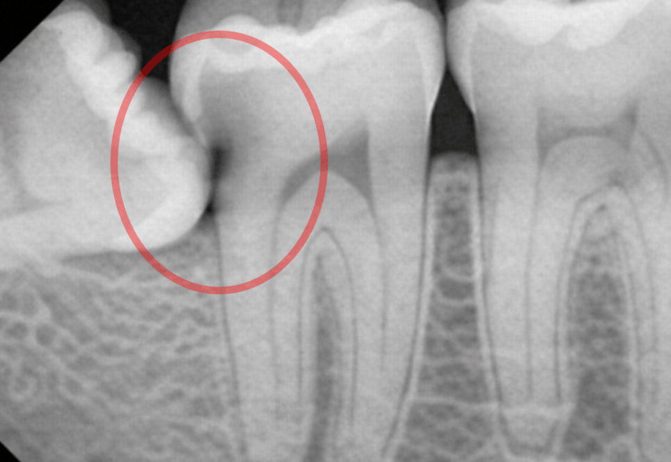 수평 매복 사랑니 예방적 발치가 필요할 때는? 선유도역 치과 Ft. 인접치 우식 & 치조골 흡수 등 관련 이미지 3