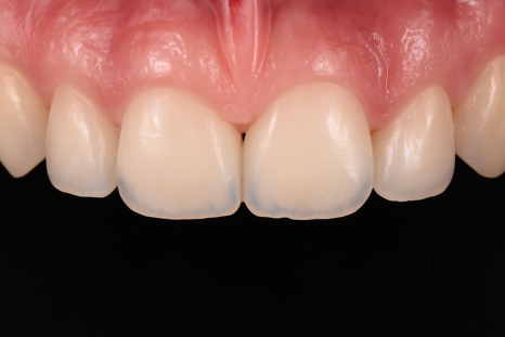 당산역 치과 아이콘 레진이란? : 치아 탈회 및 교정 치료 후 화이트 스팟 관련 이미지 8