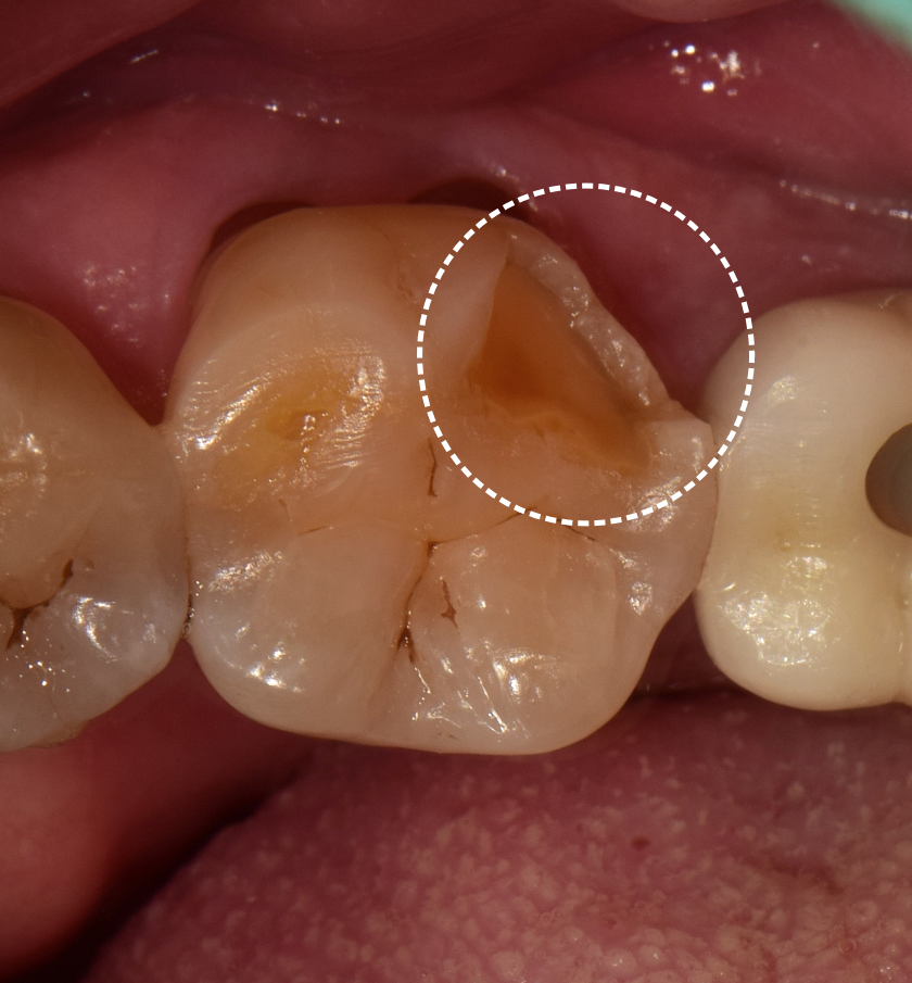 Why a Tooth Crown Is Needed After Root Canal Treatment at a Dental Clinic Near Yeongdeungpo-gu Office Station image 2