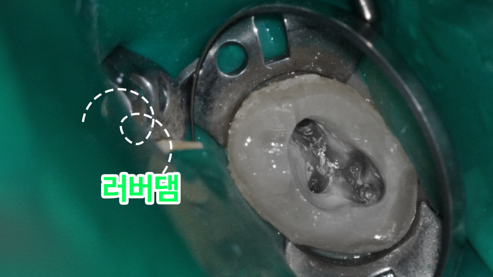 당산동 치과 미세현미경을 활용한 재신경치료 : MB2 근관을 찾아라! 관련 이미지 7